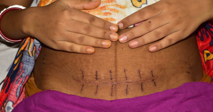 C-Section Scars: Types, Healing, Treatment, and More