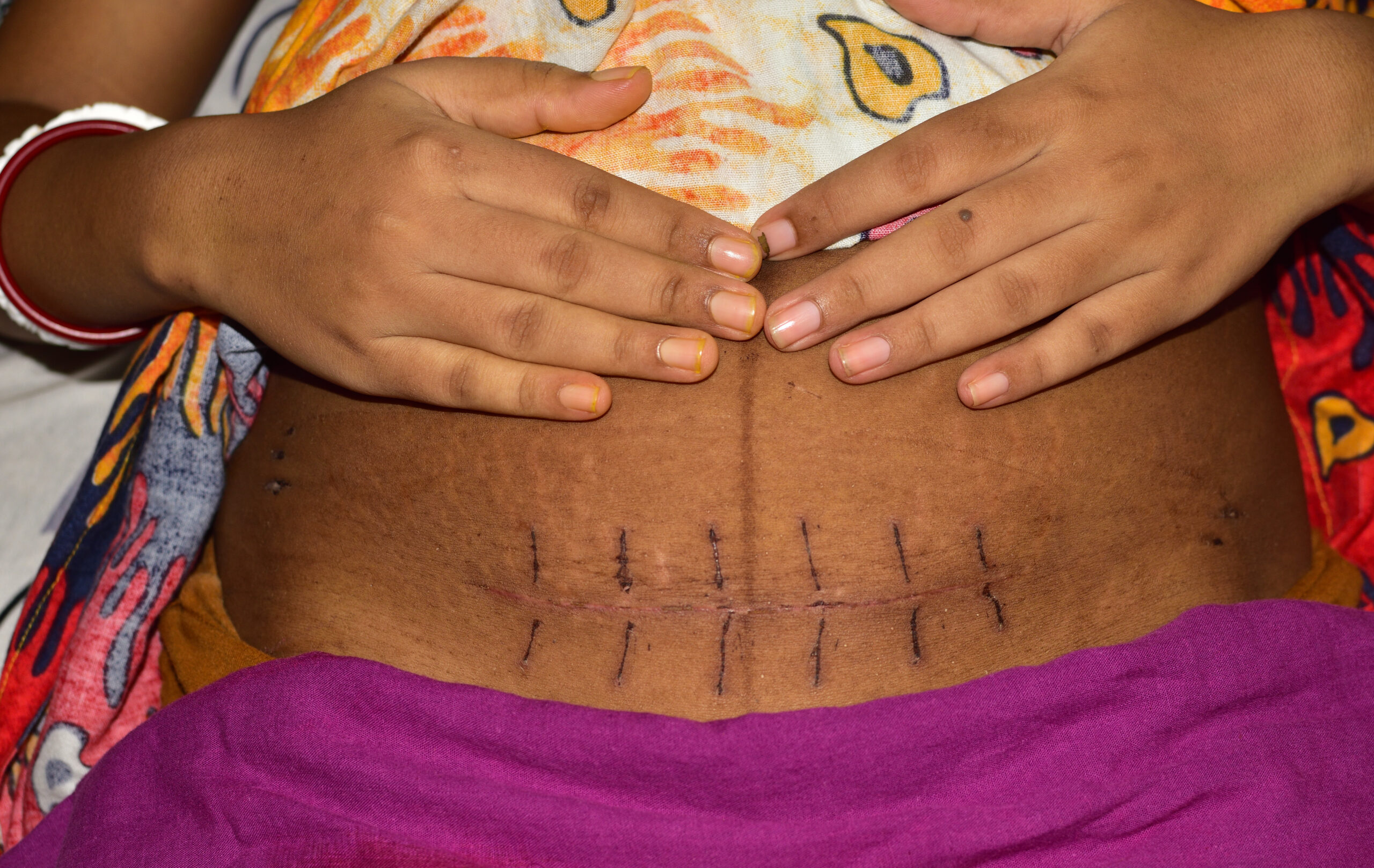 Caesarean Scars – Management of C-Section scars